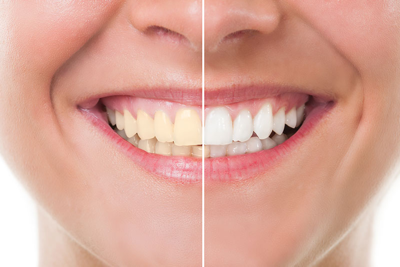 Teeth Whitening Trays in Lincoln