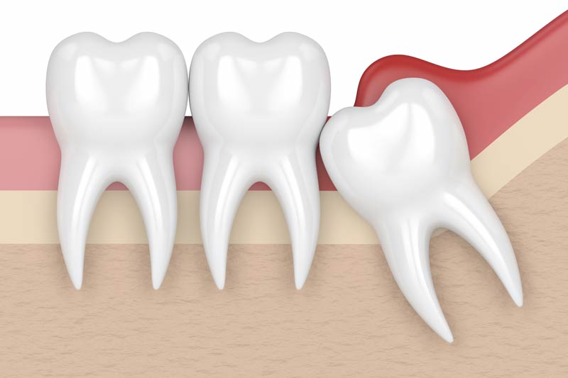 Wisdom Tooth Removal in Lincoln